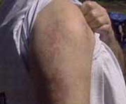 Toxins caused a skin rash. Toxins caused a skin rash.