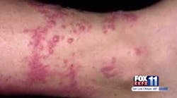 Santa Barbara County firefighter Danny Haynes suffered exposure to poison oak at two fires this summer. Santa Barbara County firefighter Danny Haynes suffered exposure to poison oak at two fires this summer.