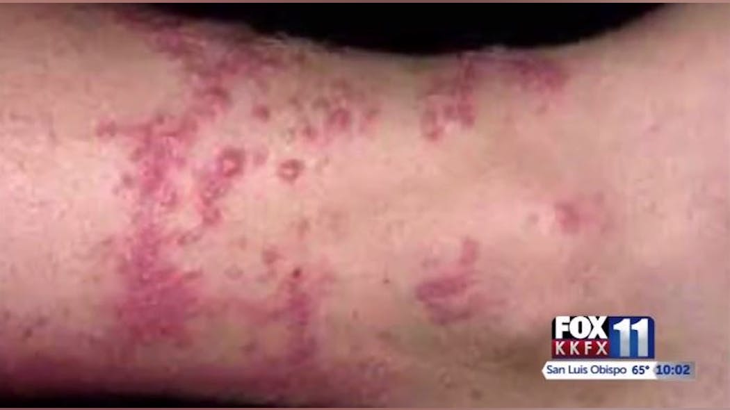 Santa Barbara County firefighter Danny Haynes suffered exposure to poison oak at two fires this summer. Santa Barbara County firefighter Danny Haynes suffered exposure to poison oak at two fires this summer.