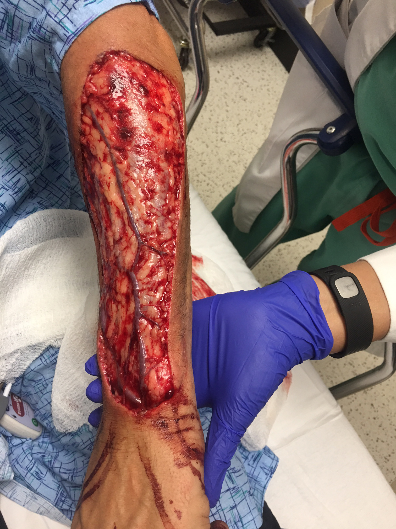 As a result of the bite, Shireman&rsquo;s left arm was seriously injured: The skin was completely removed from below the elbow to the top of the wrist.