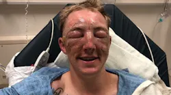 Cal Fire firefighter Brandon Feller after suffering severe burns while fighting the Klamathon Fire in Siskiyou County.