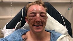 Cal Fire firefighter Brandon Feller after suffering severe burns while fighting the Klamathon Fire in Siskiyou County. Cal Fire firefighter Brandon Feller after suffering severe burns while fighting the Klamathon Fire in Siskiyou County.