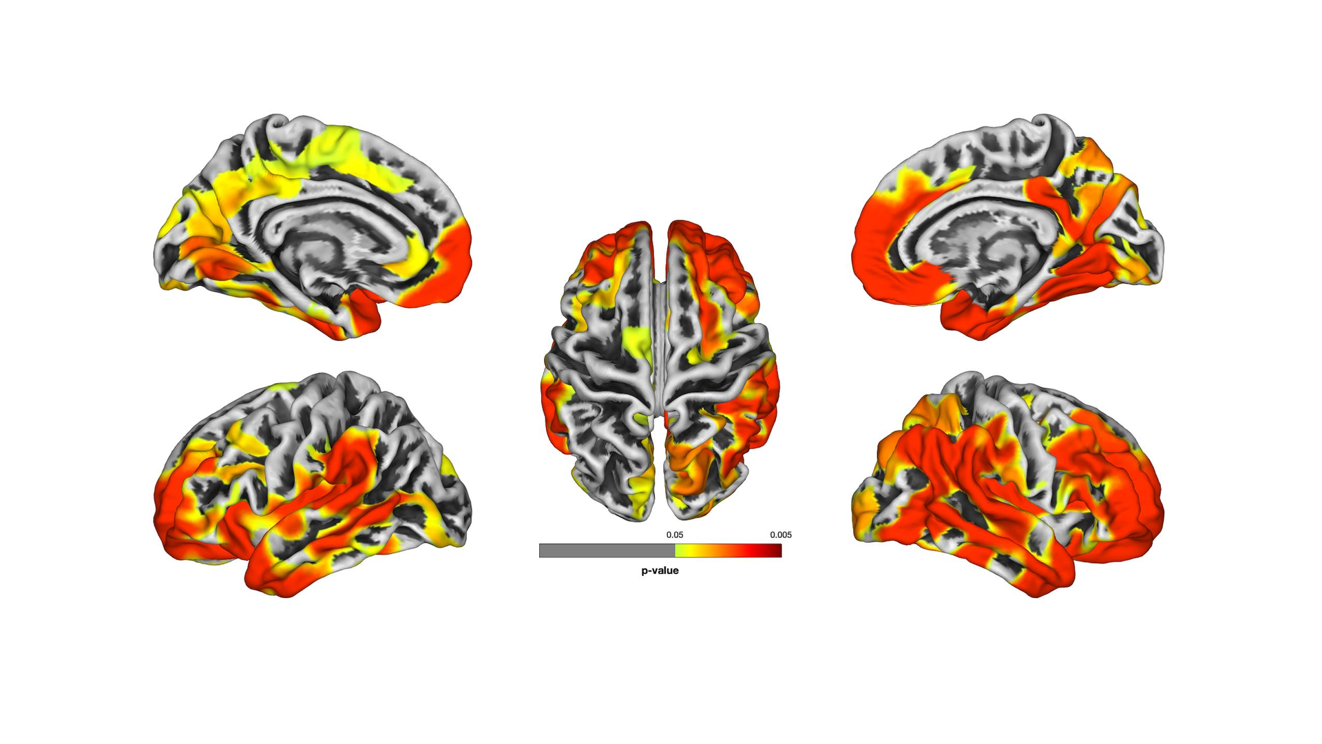 These brain images are a compilation of MRI results from WTC responders. The images show gray matter atrophy on the brain, with yellow and red areas revealing statistically significant atrophy compared to the normal population. Red areas show worse atrophy than yellow.