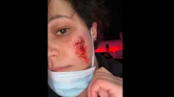 Bite2