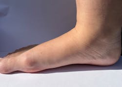 From left to right, a flat foot, a high arch foot and a neutral foot. From left to right, a flat foot, a high arch foot and a neutral foot.